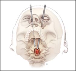 Novel Approach Spares Major Nerves, Blood Vessels, Other Structures in Difficult-to-Reach Area