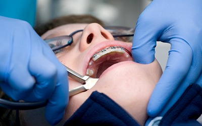 Orthodontics procedure shown in a stock photo.