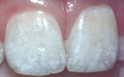 Two front teeth show signs of moderate fluorosis (excess fluoride)